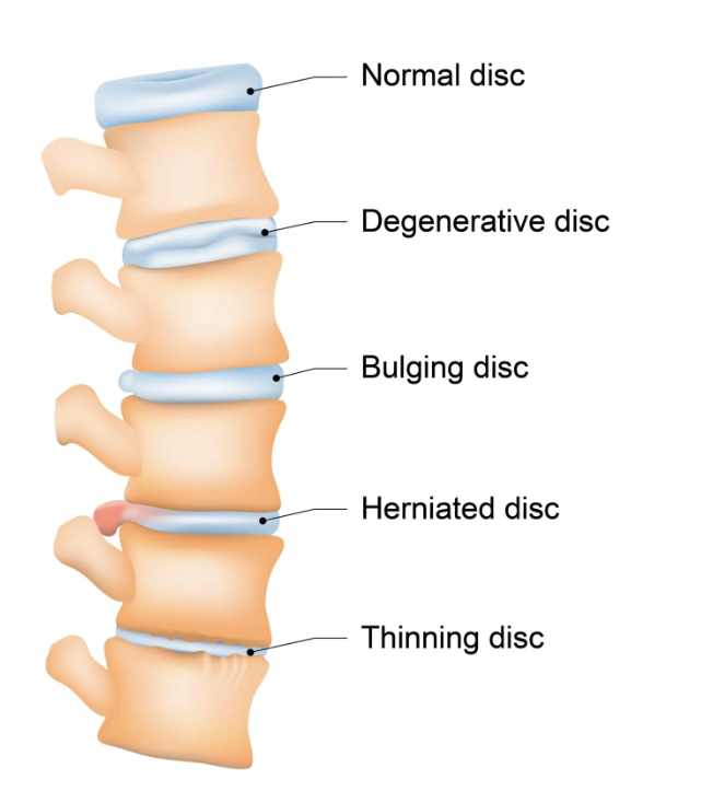 back-pain-columbus-physical-therapy-columbus-humphrey-norfolk-ne